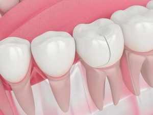 Broken Tooth Filling cracked