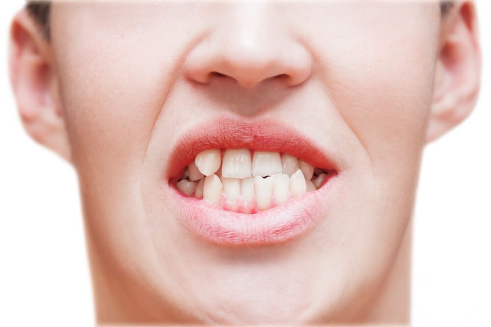 Crooked Teeth Treatment in West Ryde: 3 Orthodontic Solutions