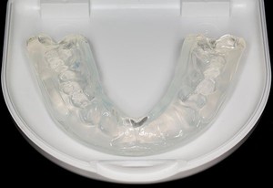 Dental Night Guards for Tooth Grinding at My Local Dentists West Ryde