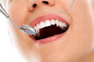 Tooth Fillings | Dentist West Ryde