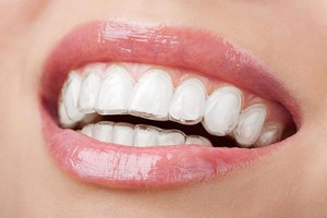 My Local Dentists West Ryde Invisalign | Dentist West Ryde