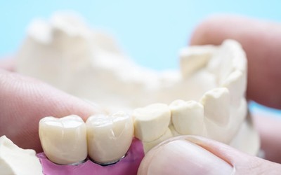 Do “Permanent” Dental Crowns Last Forever?