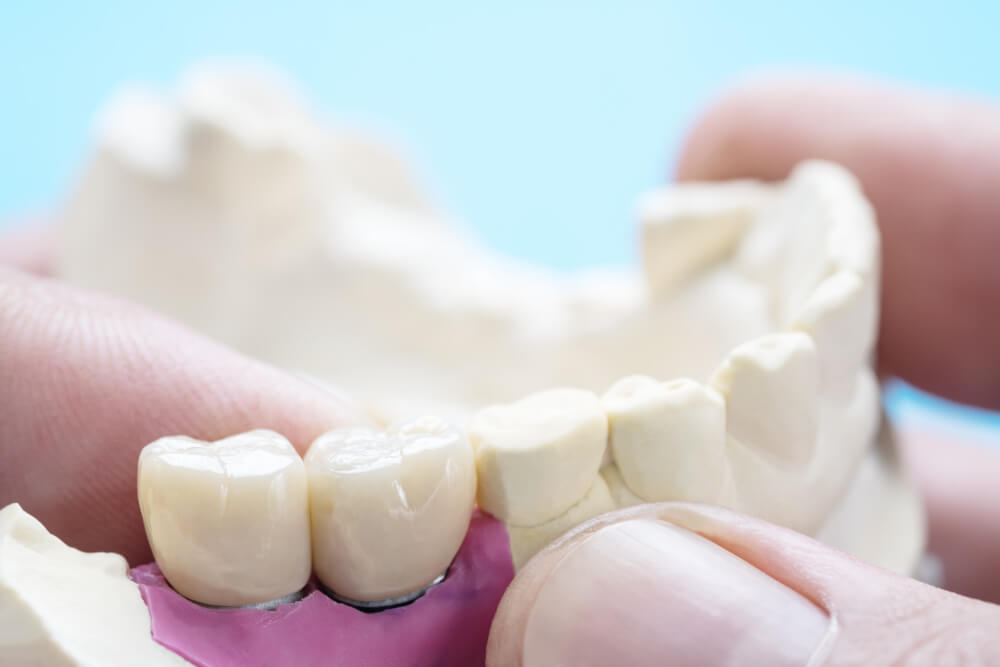 Do “Permanent” Dental Crowns Last Forever?
