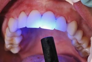 Dental Bonding | Dentist West Ryde