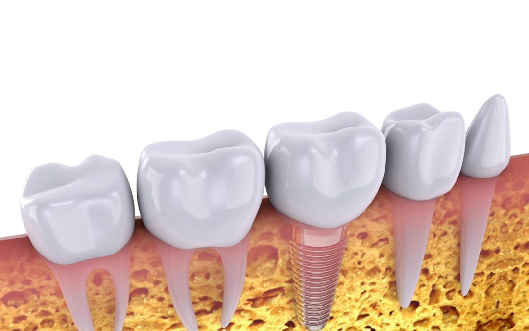 “Dental Implants Procedure Simplified” Video