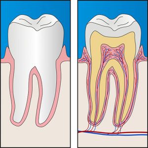 Root Canal Therapy | Dentist West Ryde