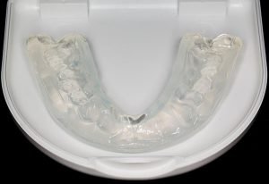 Teeth Grinding Solution | Dentist West Ryde