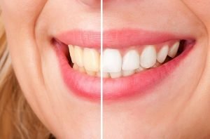 Teeth Whitening | Dentist West Ryde