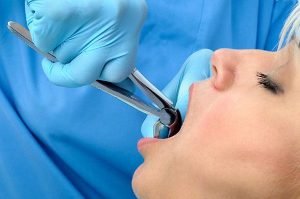 Tooth Extractions | Dentist West Ryde