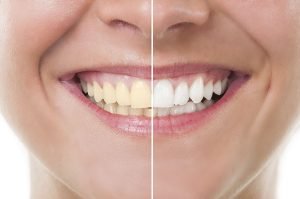 How to Get Rid of Yellow Teeth Instantly?