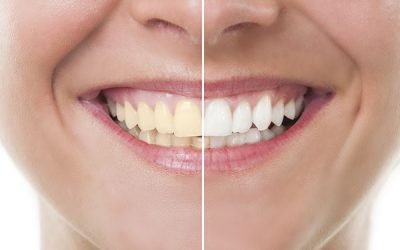 How to Get Rid of Yellow Teeth Instantly?