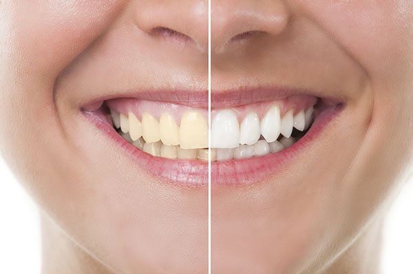 How to Get Rid of Yellow Teeth Instantly west ryde dentist
