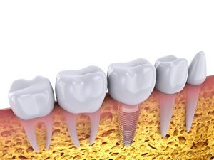 Dental Implants How Long Can They Last | Dentist West Ryde