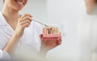 Dental Implants – How Long Can They Last?