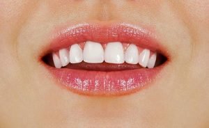 6 Tips To Keep For Healthy White Teeth In West Ryde 