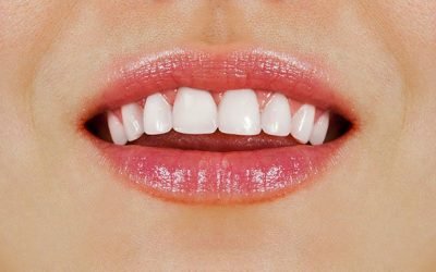 6 Tips To Keep For Healthy White Teeth In West Ryde