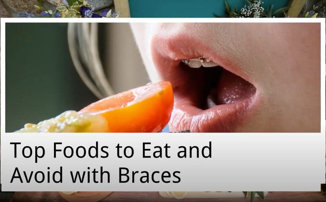Top Foods to Eat and Avoid with Braces from My Local Dentists West Ryde