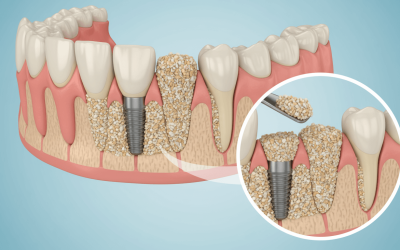 Bone Graft for Dental Implants: Why It’s Needed and What to Expect Before Treatment