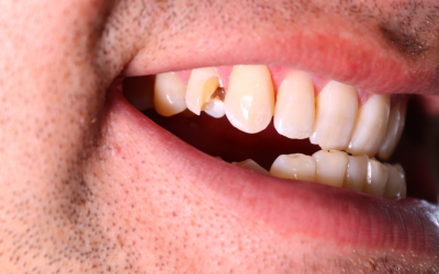 Broken Wisdom Tooth: Causes, Symptoms and Treatment Options